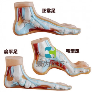“康為醫(yī)療”正常足、扁平足、弓型足模型