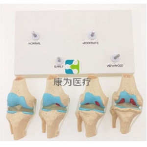 “康為醫(yī)療”四階段病變膝關(guān)節(jié)模型，4階段膝關(guān)節(jié)模型
