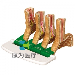 “康為醫(yī)療”醫(yī)患關(guān)系溝通模型-胃食管反流?。℅ERD）模型 （醫(yī)學(xué)指導(dǎo)模型）
